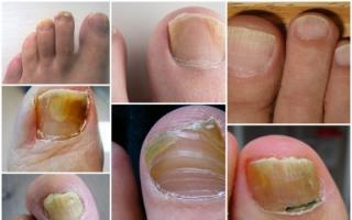 Признаки и лечение начальной стадии грибка ногтей на ногах