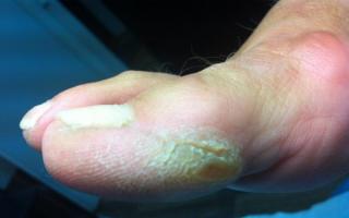 Натоптыши (сухая мозоль) на ноге на пальце и между ними – причины, фото и лечение кожных образований