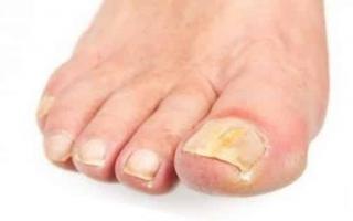 Грибок ногтей на ногах – причины, признаки, лекарства для профилактики